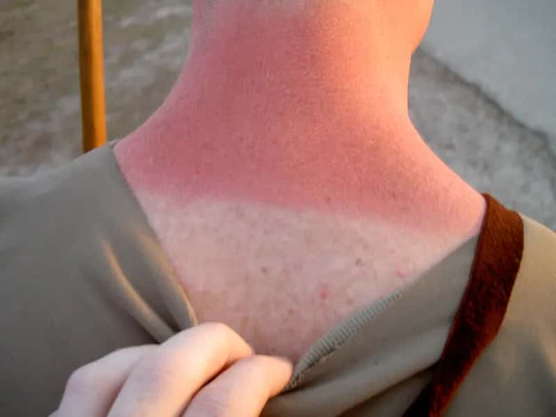 3. Sunburn severe enough to affect the whole body (By Phil Kates, CC BY-SA 2.0)