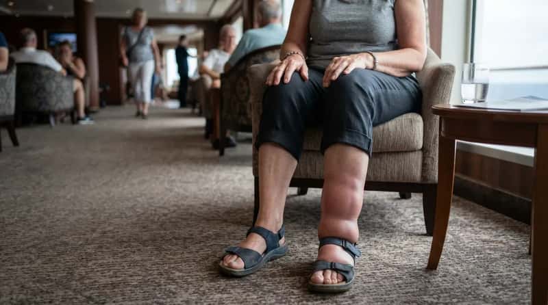 #16 - Swollen Ankles Passengers Blame on "Too Much Walking" (Image Credits: Gemini)