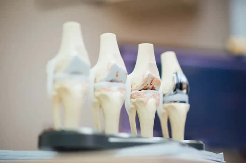 #13 - Hip and Knee Replacements Will Almost Certainly Trigger the Alarm (Image Credits: Unsplash)