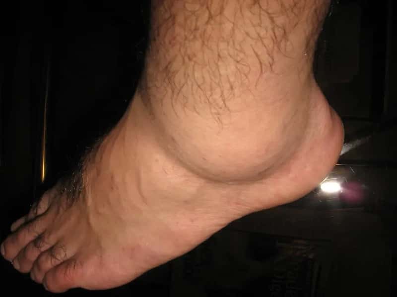 The Edema Reality Check: Nearly Everyone Is Affected (godwin d, Flickr, CC BY 2.0)